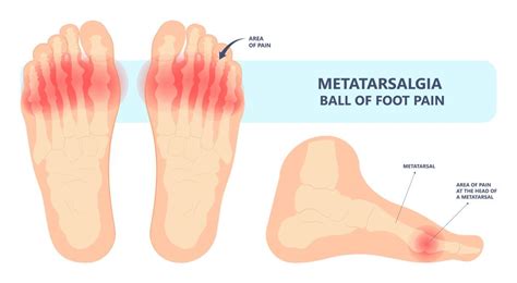 Metatarsalgia Surgery in Miami: Expert Treatment for Foot Pain