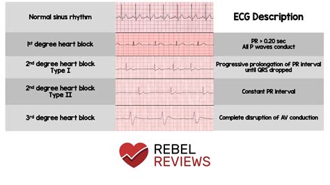 AV Heart Blocks - REBEL EM - Emergency Medicine Blog