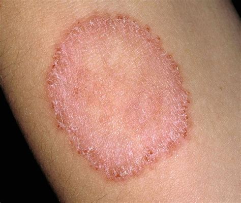 Ringworm: Pictures, Symptoms, Causes, Treatment