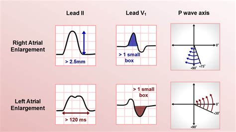 Intro to EKG Interpretation - Chamber Enlargement - YouTube