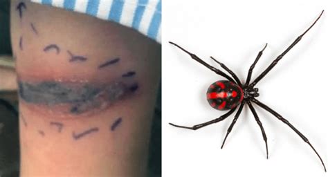 False Black Widow Bite Treatment / How to spot false widow spiders ...