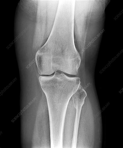 Removed kneecap, X-ray - Stock Image - C017/7981 - Science Photo Library