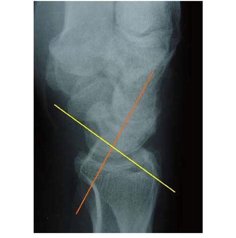 DISI deformity: Scapholunate angle >60° | Download Scientific Diagram