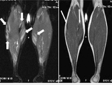 Magnetic resonance imaging (MRI) of both calves prior to therapy ...