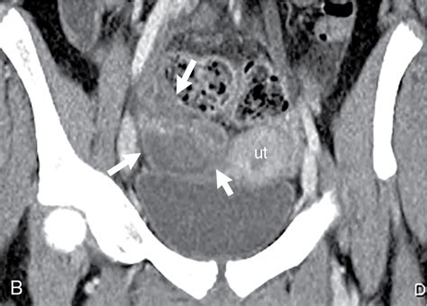 TOA (Tubo-Ovarian Abscess): Three letters you don’t want to hear ...