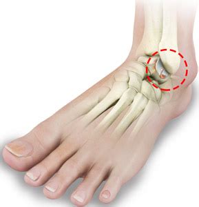 Rheumatoid Arthritis Cockeysville | Foot Arthritis Towson | Ankle ...