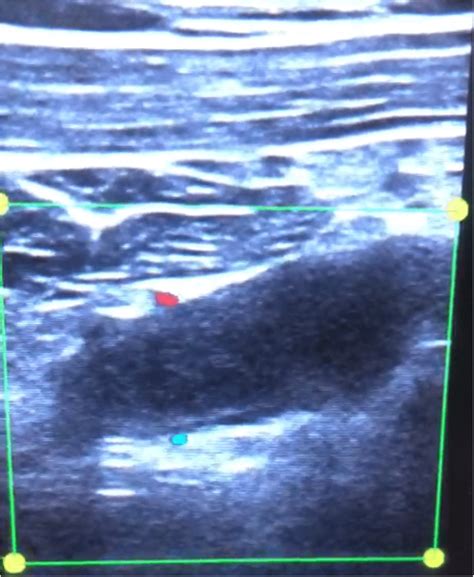 Longitudinal view of emergency ultrasound of right subclavian vein ...