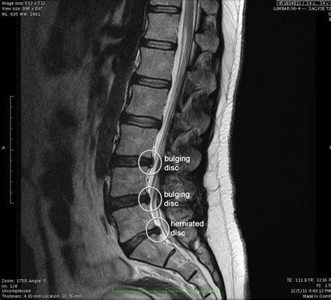 The Bulging Disc Conundrum. Note: anything written in this article ...