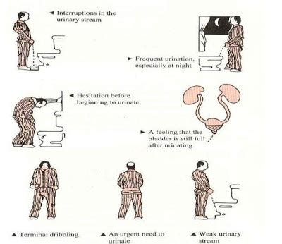 Data Suggest That Men Should Resolve to Address Their BPH Symptoms in ...