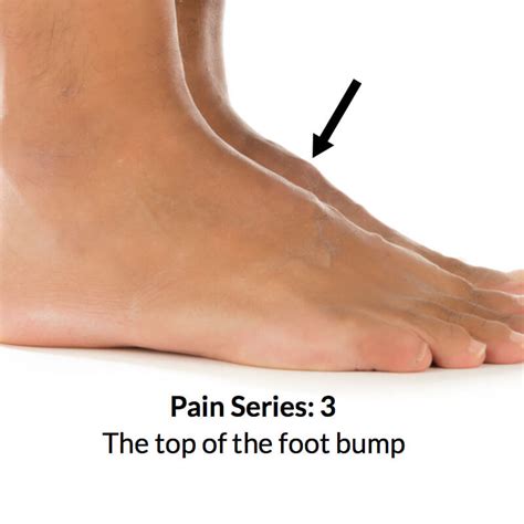 Foot bump on top of the foot - Consulting Footpain