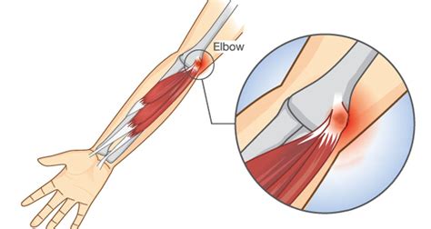 Golfer's Elbow - Symptoms, Causes, Treatment & Rehabilitation