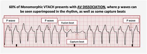 V-Fib: What Is It, Causes, Symptoms Treatment, 47% OFF