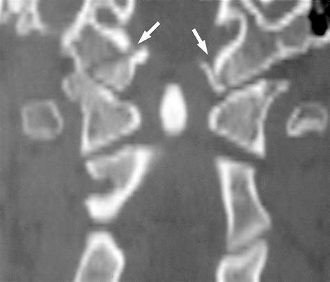 Radiologic and Clinical Spectrum of Occipital Condyle Fractures ...