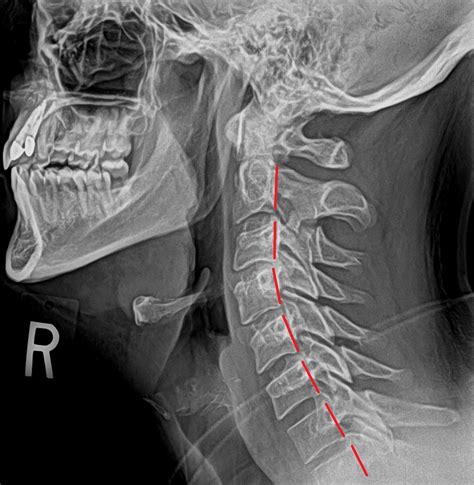 Healthy neck x-ray - Cascade Chiropractic & Wellness