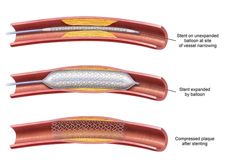 PAD Procedure Options | Azura Vascular Care