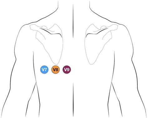 emDOCs.net – Emergency Medicine EducationPosterior-leads-V7-V8-V9-ECG ...