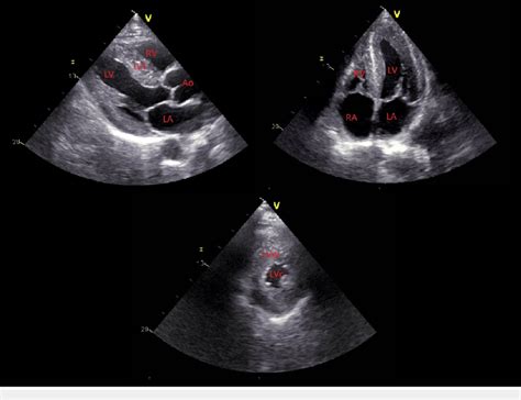 Echocardiogram Echocardiogram showing left ventricular hypertrophy and ...