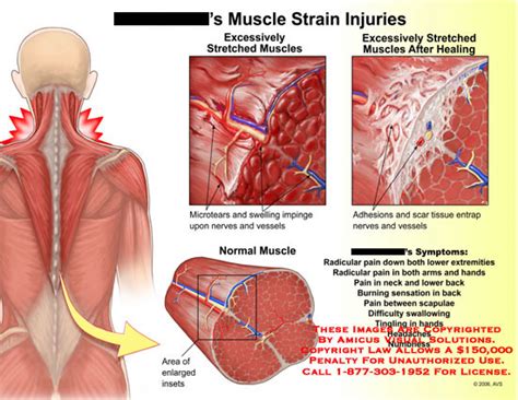 Muscle Strain Injuries