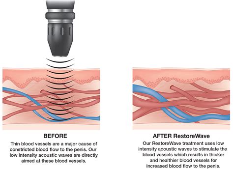 How Long Does Shockwave Therapy Take to Treat ED? - Priority Men's Medical