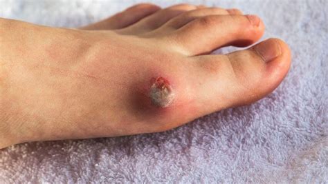 PAD Symptoms: Non-Healing Arterial Foot, Leg & Toe Ulcers | USA ...