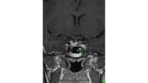 Prolactinoma MRI - wikidoc