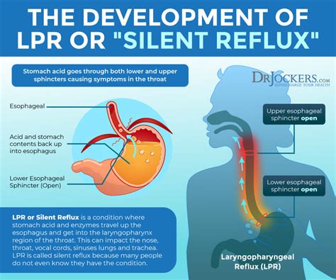 Silent Reflux: Symptoms, Causes, and Support Strategies