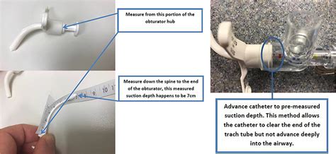 Tracheostomy Suction | Patient Education | UC Davis Children's Hospital