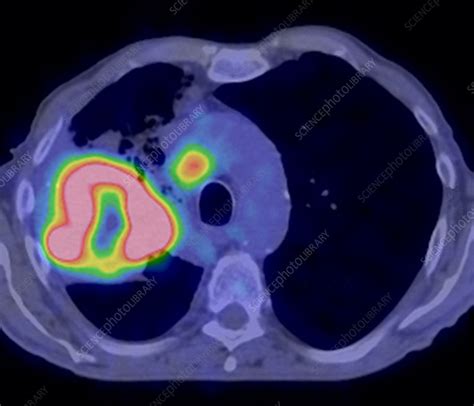 Lung cancer, CT and PET scan - Stock Image - C016/6772 - Science Photo ...