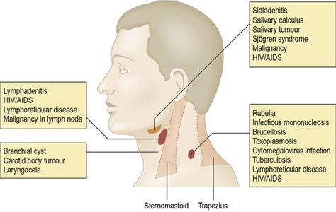 Image result for jugulodigastric | Sjogrens syndrome, Calculus, Syndrome