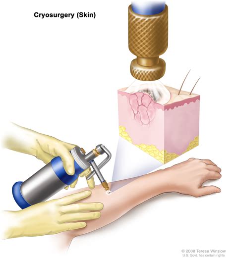 Skin Cancer Treatment - NCI