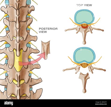 Lumbar laminectomy hi-res stock photography and images - Alamy