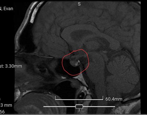 Pituitary MRI : r/Prolactinoma