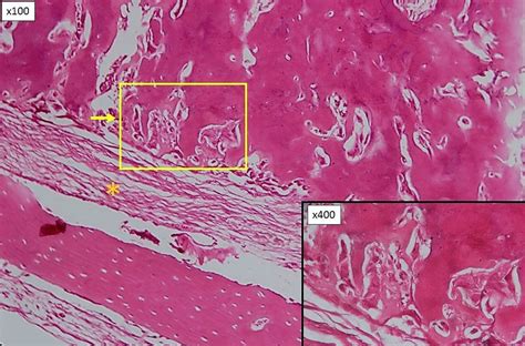 Cementoblastoma Histology