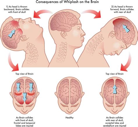 Ask Dr John - The Development of Occipital Neuralgia after a Concussion ...