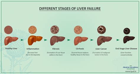 Early symptoms of cirrhosis of the liver information | Variuos