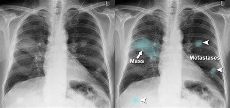 Chest X-ray - Lung cancer - Metastases (from lung)