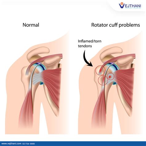 Effective Treatment for Rotator Cuff Tendinitis - Vejthani Hospital