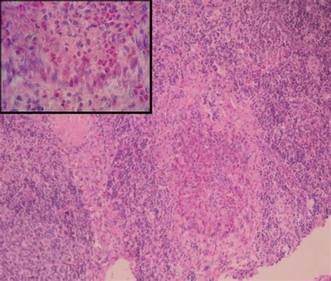 Photomicrograph of a cervical lymph node biopsy. Lymph node biopsy ...