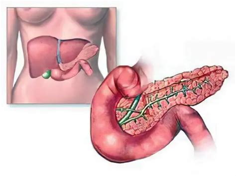 Pancreatic Necrosis - Causes And Symptoms Of Pancreatic Necrosis ...