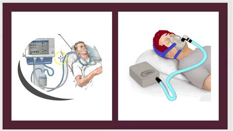 Mechanical Ventilation Positive End Expiratory Pressure PEEP COVID-19 ...