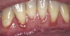 FIGURE 1 Linear gingival erythema Source Courtesy of the International ...