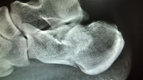 Calcaneus