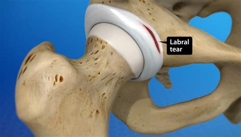 Labral Tear of the Hip (Acetabular Labrum Tear)