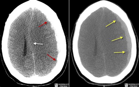 Learning Radiology - subdural, hematoma