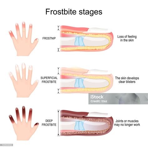 Frostbite Stages Of Fingers Stock Illustration - Download Image Now ...