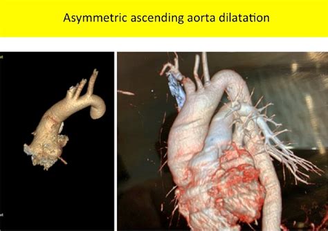 Risk of aortic dissection in patients with ascending aorta aneurysm: a ...