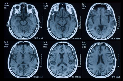 Predicting Parkinson’s? - SevenPonds BlogSevenPonds Blog