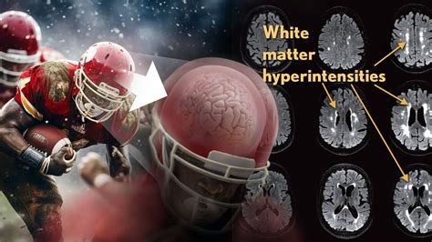 New Findings in Football Players May Aid the Future Diagnosis and Study ...