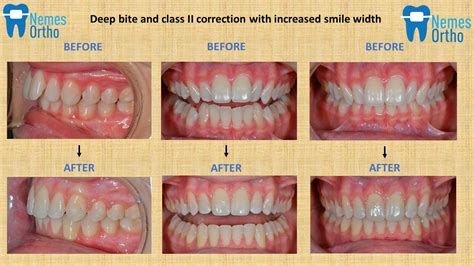 Deep Bite and Class II Correction