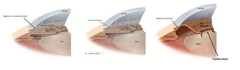 Glaucoma Information Angle closure glaucoma - Glaucoma Information